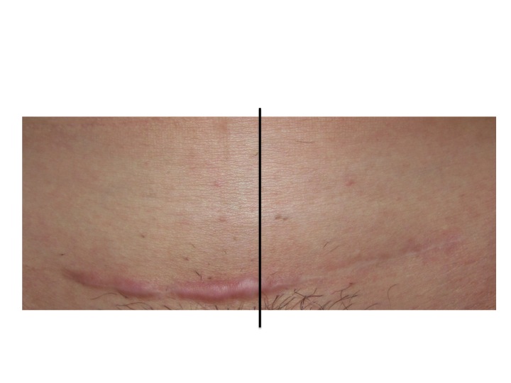 Cicatrice Taglio Cesareo Trattata Con Laser