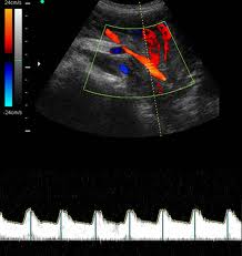 Doppler Arterie Uterine