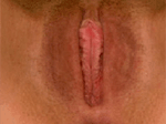 Labiaplastica Dopo