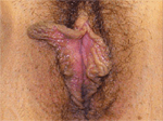 Labiaplastica Prima
